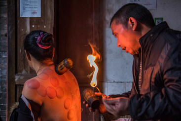 《中医针灸火罐》
