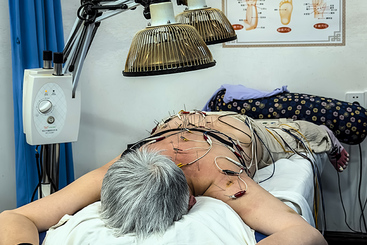 电针灸