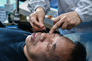 医生为患者脸部扎银针