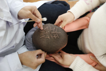 头皮针灸